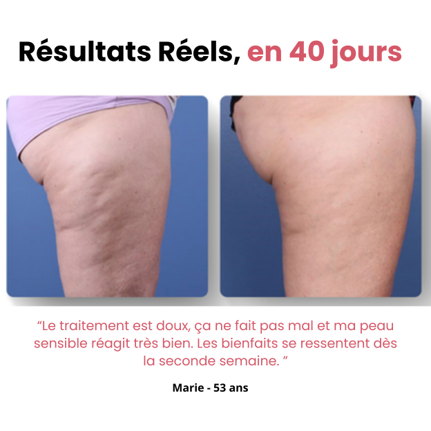 Masseur Anti-Cellulite Naurella™