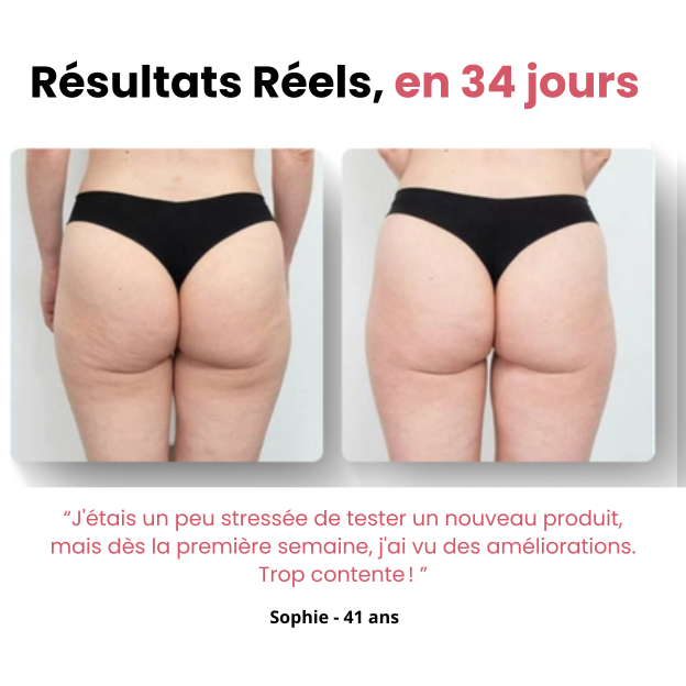 Naurella™ – Masseur Anti-Cellulite